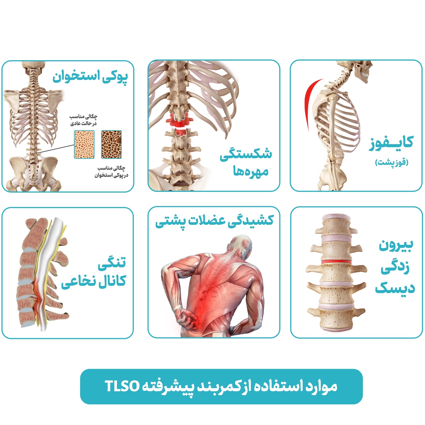 کمربند طبی اورتینو مدل TLSO